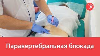 Паравертебральная блокада