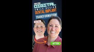 Amazing Digital Smile Design Dental Implant Transformation