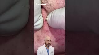 Tiny cystic pimple pop! ⭐️ (credit: @squeezezit on TT) #satisfying #trending #pimple #reaction