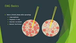 Neuropathy vs myopathy on EMG