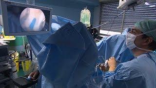 Adénome de la prostate : la chirurgie au laser - Allô Docteurs