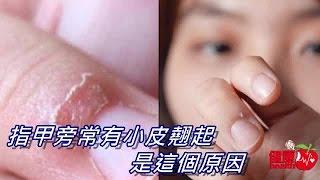 指甲旁常有小皮翹起 原因是這個 | 台灣蘋果日報