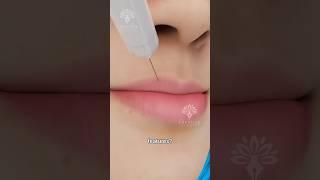 How Do Derma Fillers Actually Work #shorts #viralvideo - Creativelearning3d