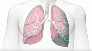 Idiopathic Pulmonary Fibrosis (IPF): Risk Factors and Diagnosis