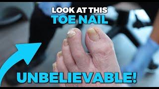 YOU WON'T BELIEVE THIS HAPPENED happened to his toe nail!