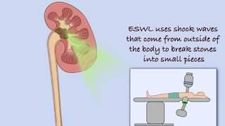 Extracorporeal Shock Wave Lithotripsy (ESWL)