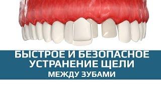 Виниры. Исправление кривизны зубов при помощи виниров