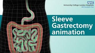 Sleeve Gastrectomy animation