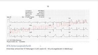 EKG in 3 Minuten [8]