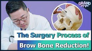 [Grand Plastic Surgery] The Surgery Process of Brow Bone Reduction