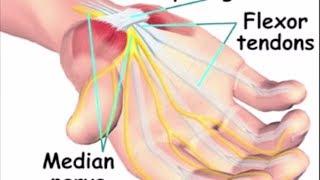 Airrosti Treatment: Carpal Tunnel Syndrome