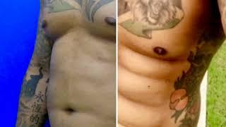 High Def VaserLipo Abdominal Etching results | Elite Plastic Surgery