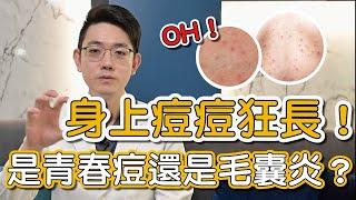 東抓抓西癢癢，遠離毛囊炎這些細節你有做到嗎？蕭全佑醫師告訴大家如何避免毛囊炎！