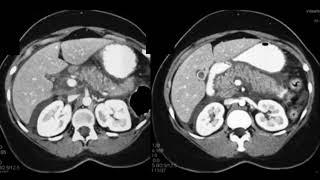 Evaluating Acute and Chronic Pancreatitis Part 1