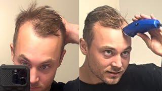 SHAVING OFF MY BALDING/RECEDING HAIR