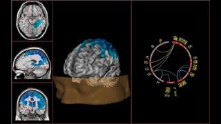 ASD diagnosis by QEEG in vesalcenter.com