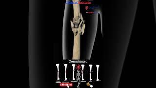 Types of bone fractures  bone fractures