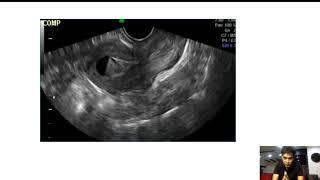 UTERINE NICHE/ ISTHMOCELE-case discussion