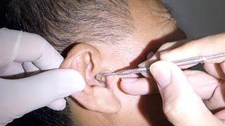 Huge Earwax Removed from GrandPa's Ear