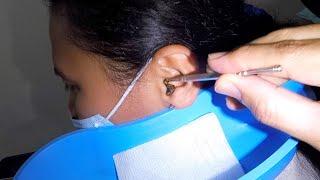 Removing Huge Woman's Earwax Using An Ear Curette