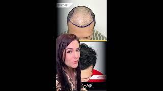 Care4Hair Transplante Capilar - Consulta Gratis