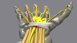 Carpal Tunnel Syndrome