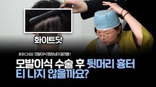 모발이식 뒷머리 수술 흉터 티 나지 않을까?