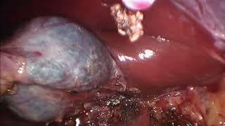 Colecistectomia e liberação de aderências laparoscópica/ Cholecystectomy and release of adhesions