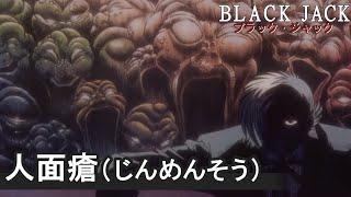 【公式】期間限定配信　ブラック・ジャックOVA 『人面瘡(じんめんそう)』