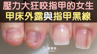 Stressful girl biting her nails Nail bed exposure and nail black line correction