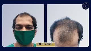 Natural looking Hair Transplant Results in Mumbai | Best Results & Cost of Hair Transplant in Mumbai