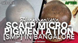 Scalp Micropigmentation in Bangalore by Eternal Expression | Hairline restoration in Bangalore