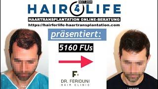 Haartransplantation Verdichtung Vorder-/Mittelkopf & Tonsur Vorher Nachher Verlauf 0/6/12 Monate