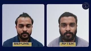 7-Month Hair Transplant Transformation | The Hair And Shape Clinic Mumbai