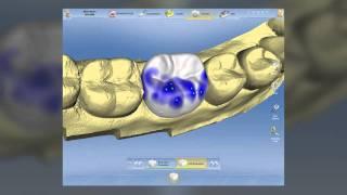 CEREC 4.0: Dr. Mark Morin's beta demo