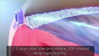 What is Selective Laser Trabeculoplasty (SLT)? SLT laser treatment for glaucoma