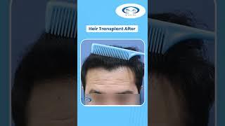 Amazing Hair Transplant Result by Dr. A’s Clinic | #shorts #shortsfeed