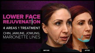 Lower Face Rejuvenation (Chin, Jawline & Jowls) With Dermal Fillers at Mabrie Facial Institute