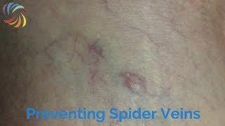 How to prevent Spider Veins?