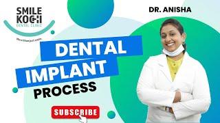 Dental Implants: Restore your Smile at Smile Kochi Dental Clinic