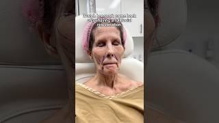 Watch Her Spark Come Back After Having a Full Facial Rejuvenation 
