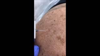 Red Mole Removal (Cherry Angiomas) Skin Deep Laser Services Virginia Fairfax County Northern VA