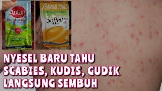 CARA MENGATASI GATAL SCABIES | AUTAN UNTUK SCABIES | @RinTans