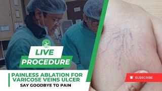 Painless Ablation for Varicose Veins Ulcer - Say Goodbye to Pain | Dr. Sandeep Sharma | IRFACILITIES