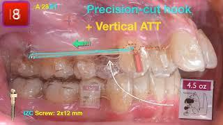 Solving Huge Overjet & Posterior Crossbite with Aligners｜【Chris Chang Ortho】CC647