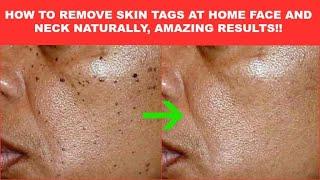 SKIN TAGS, LOOK WHAT I USE TO REMOVE  SKIN TAGS ON MY FACE AND NECK, HOW TO REMOVE SKIN TAGS FAST