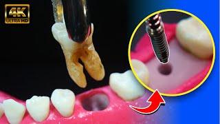 FASINATING dental IMPLANT process in 4K