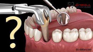 Tooth extraction