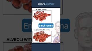 Exploring Emphysema  #Emphysema #RespiratoryCare #nclexrn