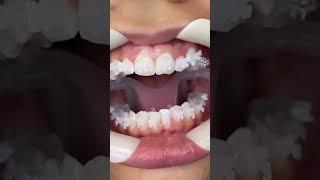 BRACES ON‼️🫶#reels #shullmanorthodontics
